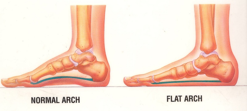 Prevention Of Flatfoot For Children