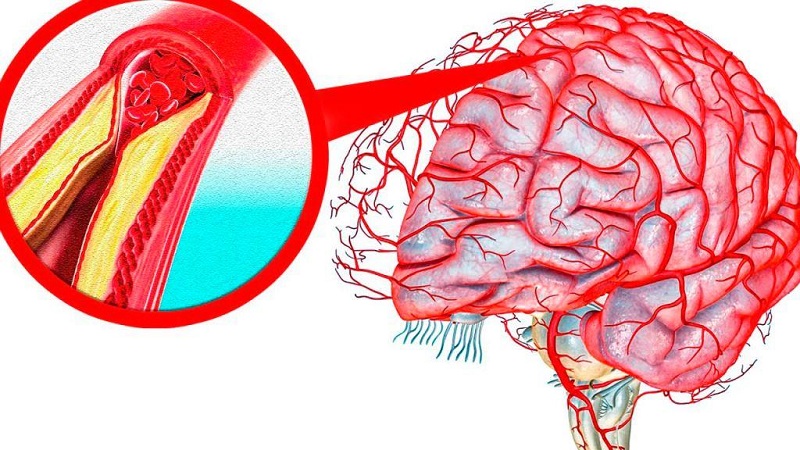How To Strengthen The Vessels Of The Brain?